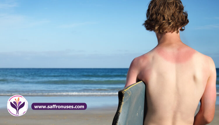 saffron uses for Treatment of sunburn