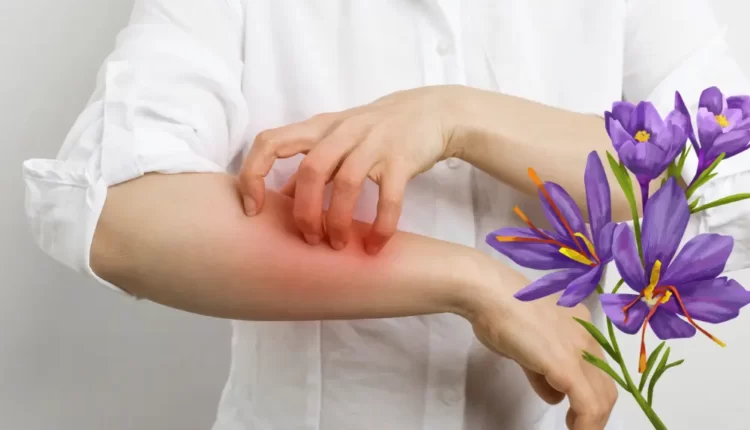 Saffron Allergy Symptoms and PreventionL | The Link Between Saffron and Hives